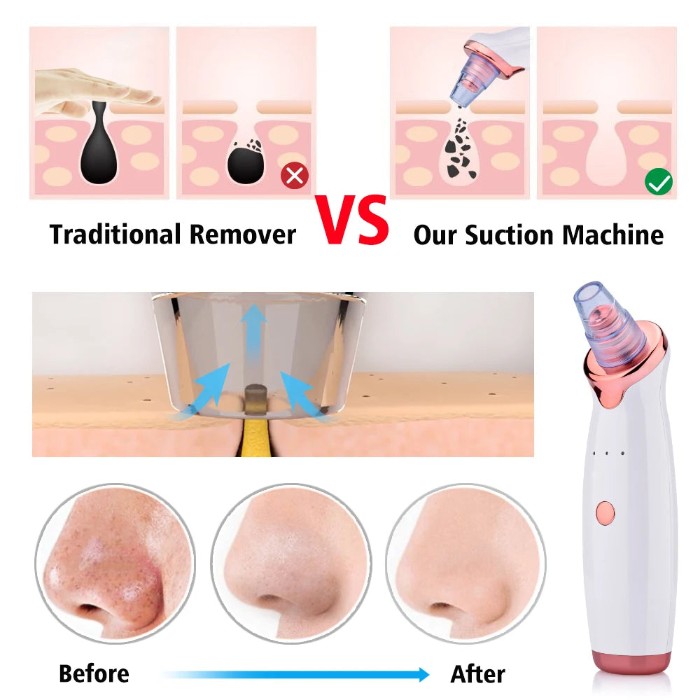 USB Vacuum Blackhead Remover Tool